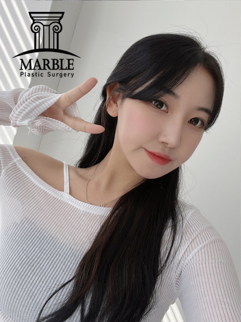 쌍꺼풀수술비용, 합리적인 변화는 마블성형외과의원! 관련 이미지 5