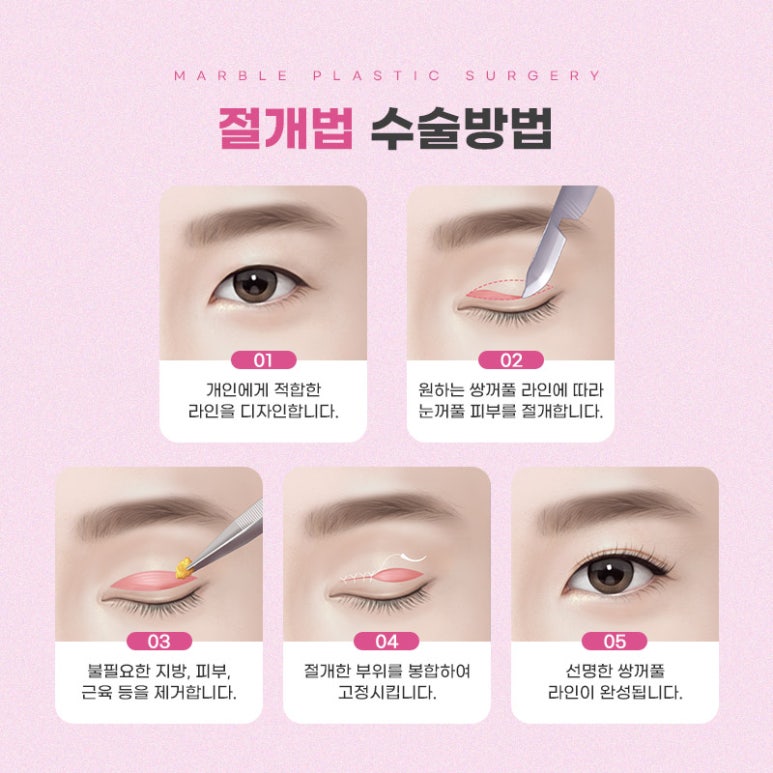 쌍수절개법 자연스러움을 더하다! 마블성형외과 관련 이미지 5