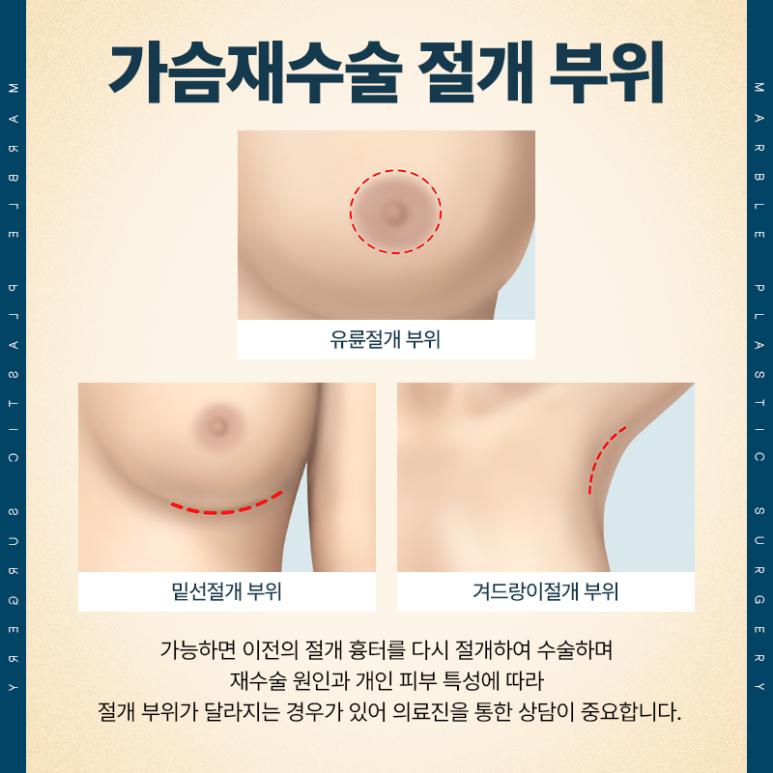 구형구축으로 인한 가슴성형 재수술, 어떻게 해결할까? 관련 이미지 3