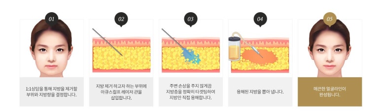 이중턱리프팅 매끄러운 브이라인으로 마블성형외과의원 관련 이미지 5
