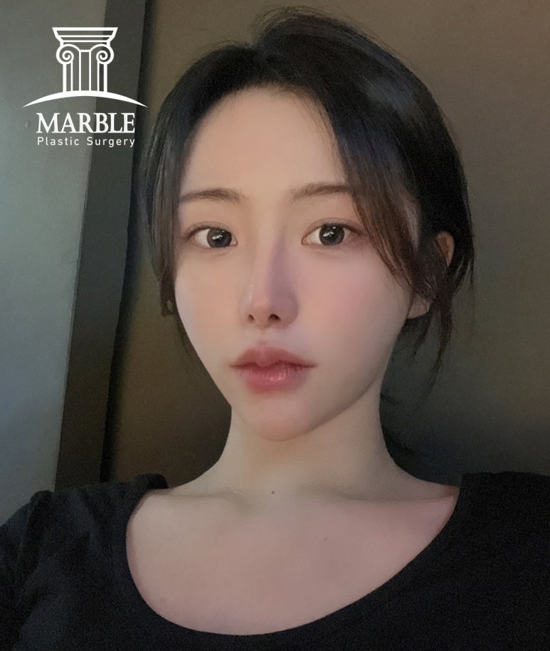 눈재수술 더 신중하게 고민해서 관련 이미지 7