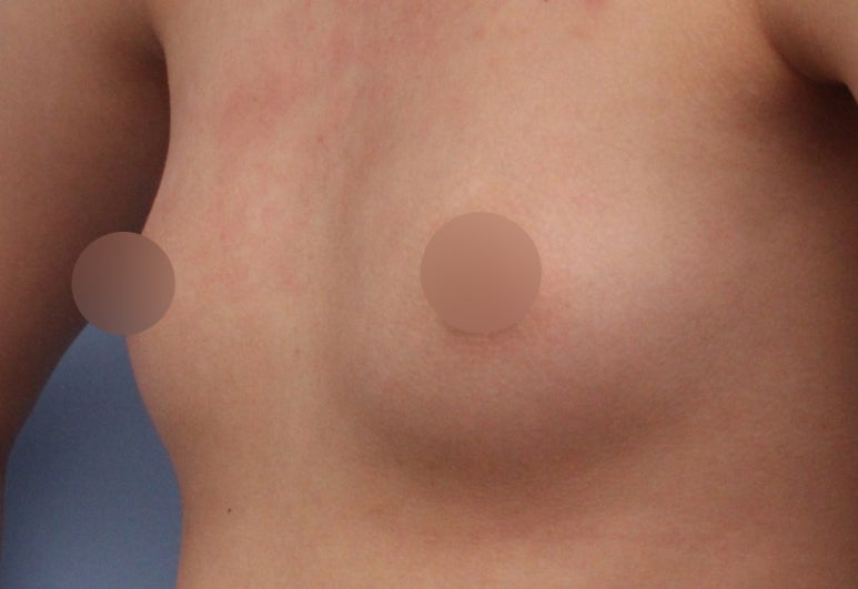 가슴성형 잘하는곳 : 보형물, 가격, 첫 수술 계획까지 관련 이미지 1