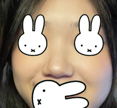 [강남성형외과 복코성형 후기] 두꺼운 피부라 얄쌍해지기 어렵다던 제 복코.. 지금은 콧볼까지 얇아졌어요 관련 이미지 4