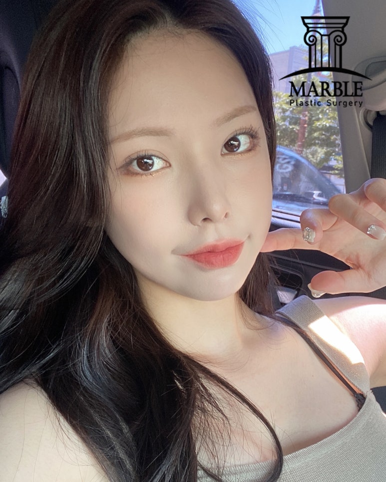 눈밑지방재배치, 뚜렷한 인상을 주기 위해 마블성형외과의원 관련 이미지 2