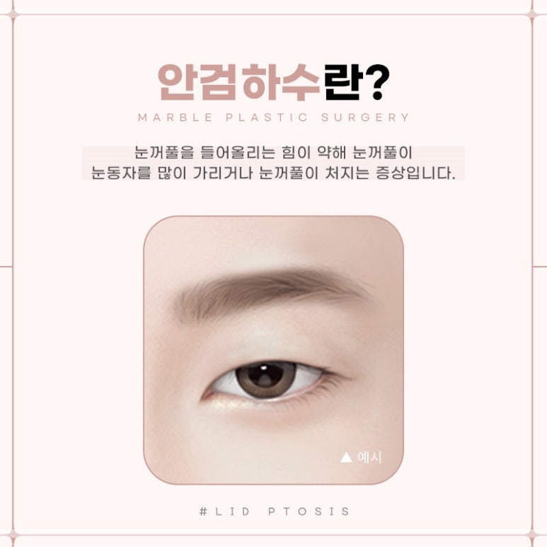눈성형잘하는곳의 수술과 눈매교정에 대하여 관련 이미지 6