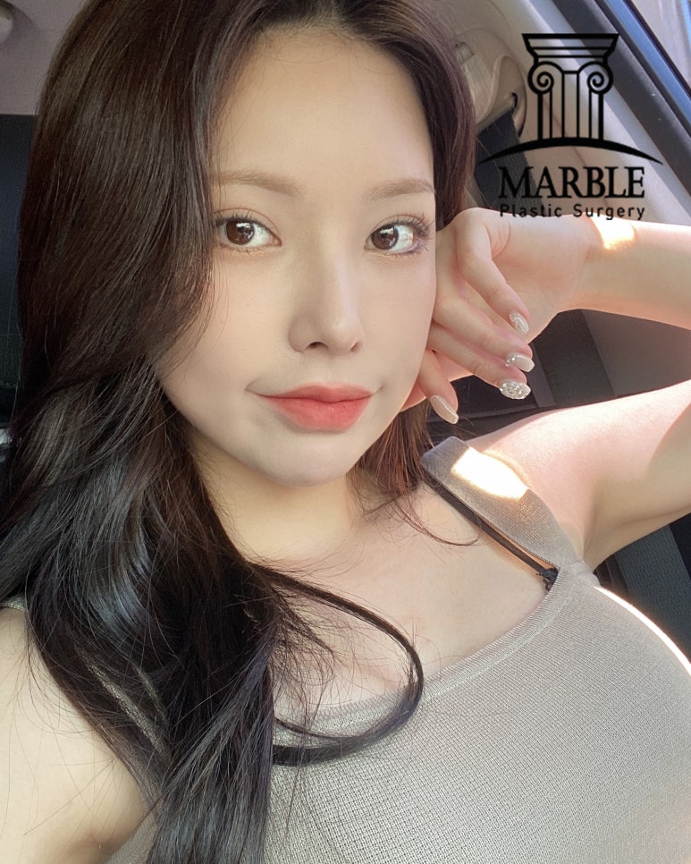 눈밑지방재배치, 뚜렷한 인상을 주기 위해 마블성형외과의원 관련 이미지 3