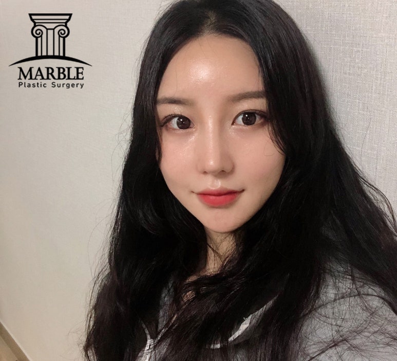 강남역성형외과, 쌍꺼풀후기 첫 눈에 반하는 눈! 관련 이미지 3