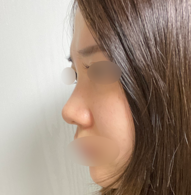 [Gangnam Plastic Surgery Revision Rhinoplasty Review] My bulbous nose showed no improvement at all… I found the nose shape I’ve always wanted after meeting Dr. Junhyung Kim haha image 3