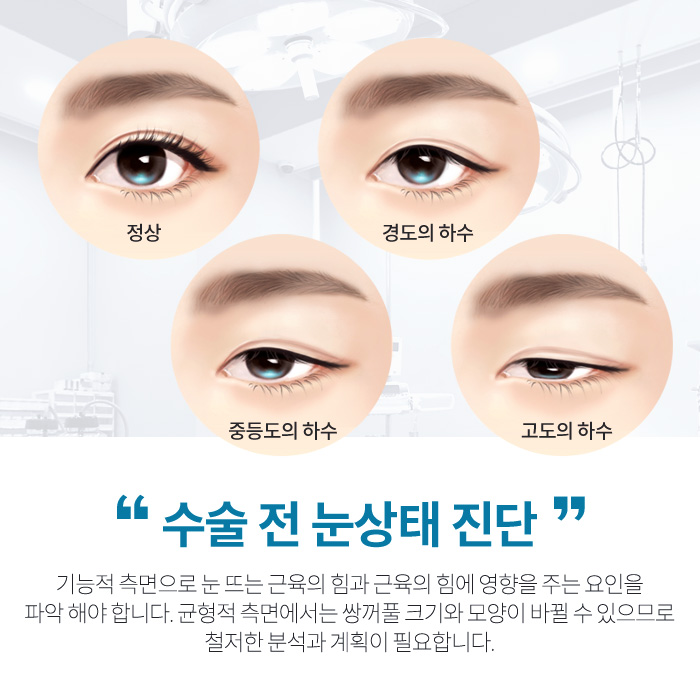 비절개눈매교정 개인 차이에 따라 마블성형외과의원 관련 이미지 3