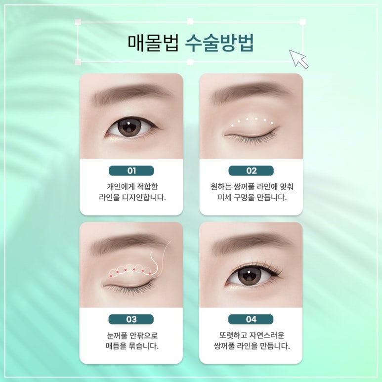 고등학생쌍수 마블이벤트에서 확인, 성형붓기빼는법은 덤으로 관련 이미지 5