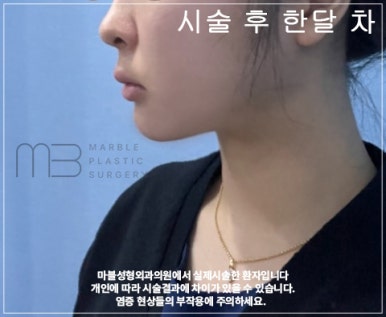 마블성형외과의 V업주사 (브이업주사), 왜 특별할까? (전후사진O) 관련 이미지 7