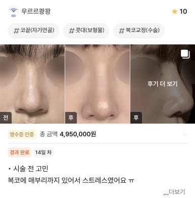 [강남성형외과 복코수술 후기] 사진 찍기 두렵던 뭉툭한 코.. 김준형원장님 만나고 세련된 라인이 됐어요! 관련 이미지 1