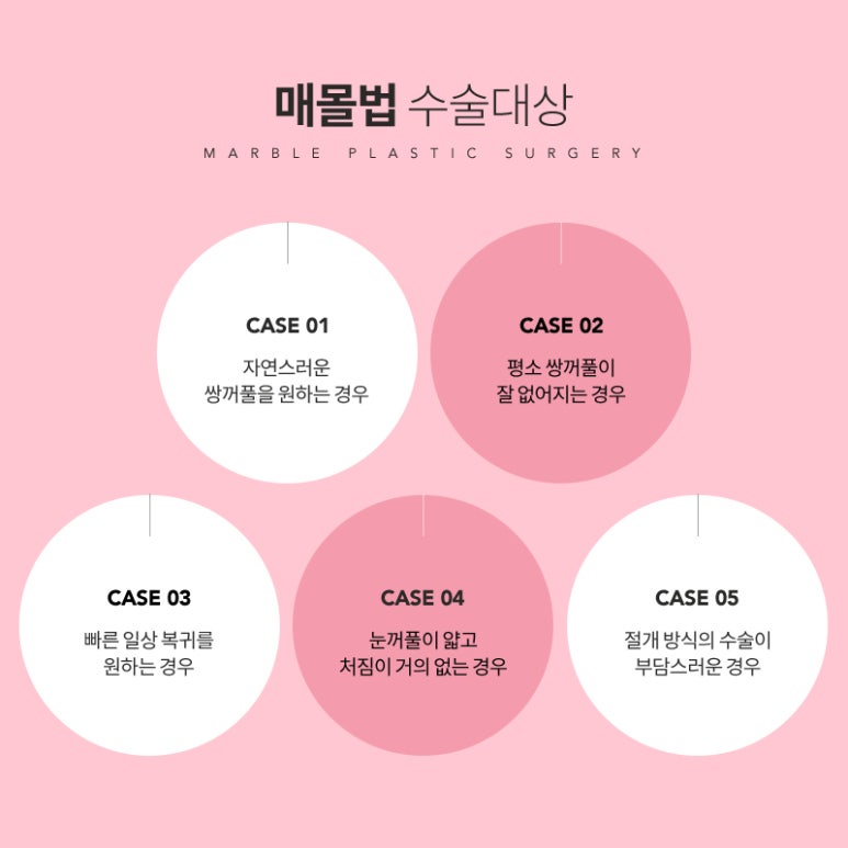 쌍꺼풀매몰후기 찾아보고 있다면 관련 이미지 4