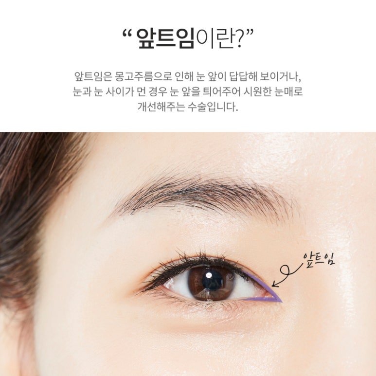 앞트임가격 시원한 눈매로 개선해 관련 이미지 2
