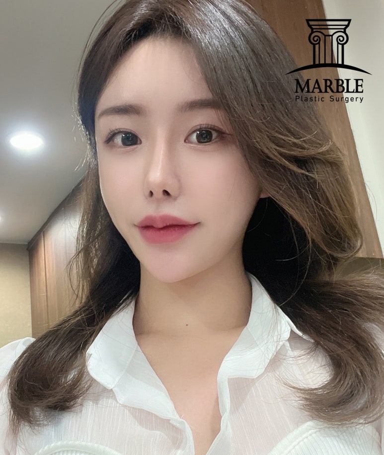 눈재수술 더 신중하게 고민해서 관련 이미지 3