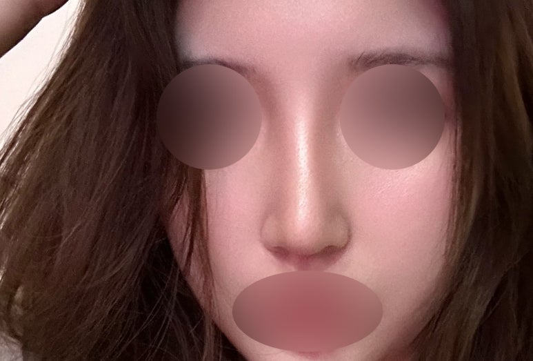 서초구 코수술 잘하는곳 마블성형외과에서 예쁜 코라인으로 변화 관련 이미지 5