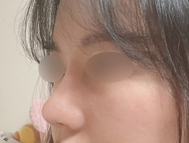 [Gangnam Station Plastic Surgery Clinic Bulbous Nose Rhinoplasty Review] My nose used to spread when I smiled and caused me stress... Now I’ve found the nose of my dreams! Haha image 7