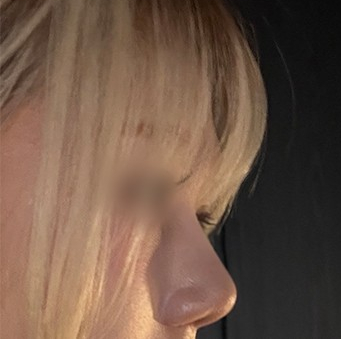 [Gangnam Plastic Surgery Hump Nose Surgery Review] The Bulky, Humped Nose That Looked Thick... A Refined Impression Achieved Without an Implant, haha image 5