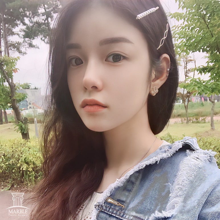 눈재수술비용 알아보고 있다면 관련 이미지 6