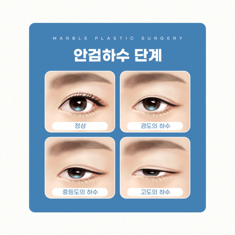 강남눈매교정 더 또렷하게 마블성형외과의원 관련 이미지 4