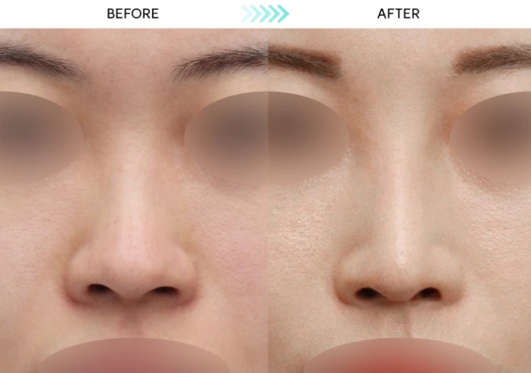[First Rhinoplasty] Three Months After Hump Nose Correction: The Standard Approach to Nasal Tip Osteotomy and Hump Nose Correction image 3