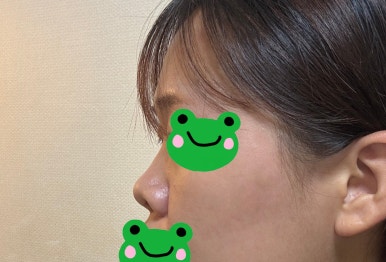 [Gangnam Plastic Surgery Rhinoplasty Review] My Short Nose Looked Upturned from the Front… Now It Has the Perfect Line with Postoperative Care Too! image 1