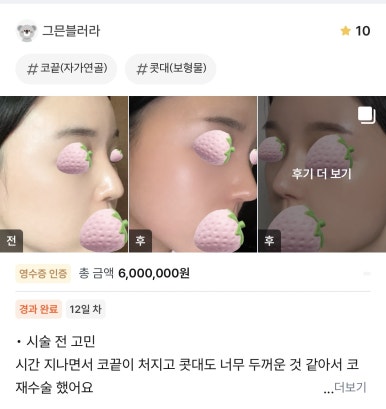 [강남성형외과 코재수술 후기] 무너졌던 코 기둥..ㅠㅠ 반년 발품 고생 끝에 인생 옆라인 찾았어요! 관련 이미지 1