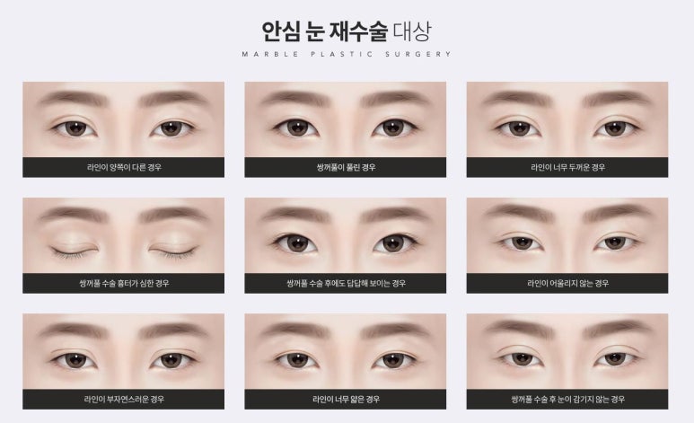 쌍꺼풀재수술잘하는곳 만족도를 위해 관련 이미지 4