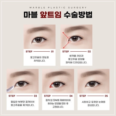 눈성형잘하는병원, 쌍꺼풀수술, 트임수술 관하여 관련 이미지 9