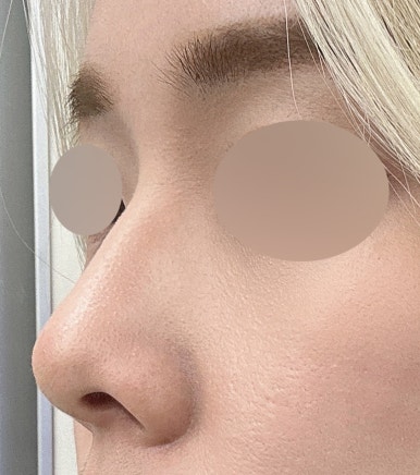 [Gangnam Plastic Surgery Clinic Hump Nose Surgery Review] Worried It Might Look Unnatural, I Hesitated About My Hump Nose… Adding Bulbous Nose Correction Helped Me Settle on My Perfect Nose Line! image 3