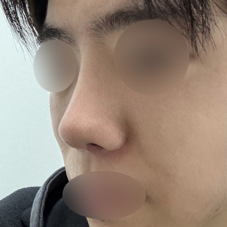 Improving Your Impression Before and After Male Rhinoplasty image 7