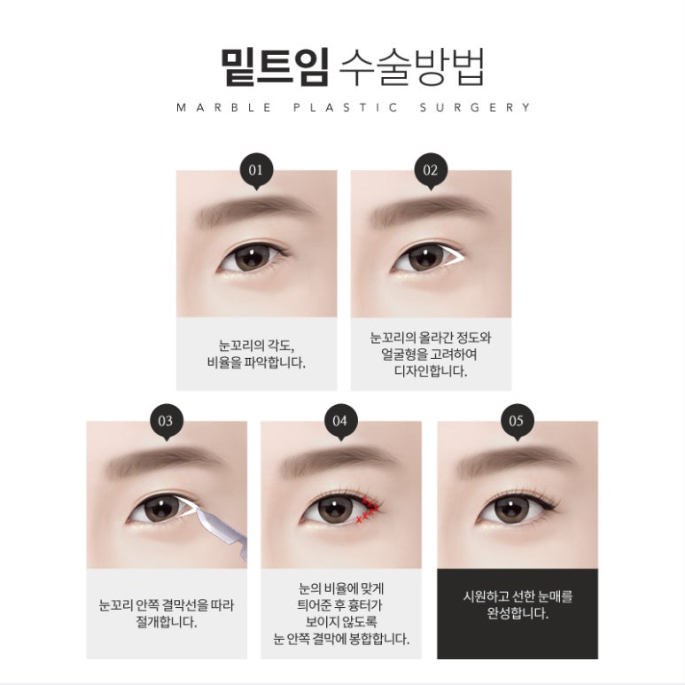 눈밑트임 부드러운 이미지로! 마블성형외과의원 관련 이미지 7