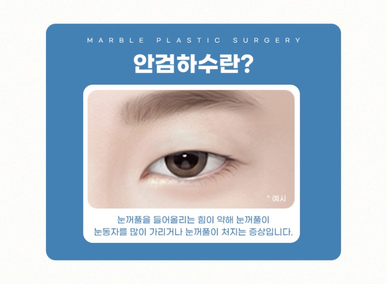 강남눈매교정 더 또렷하게 마블성형외과의원 관련 이미지 3