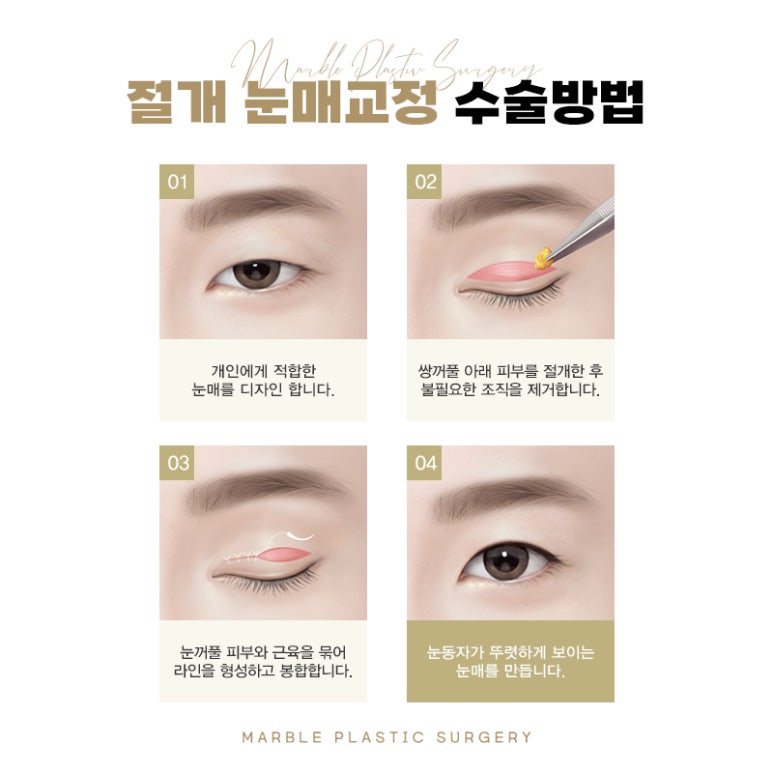 눈매교정부작용 벗어날 방법 알아보기 관련 이미지 9