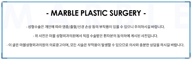 눈재수술 잘 알아봐야 관련 이미지 14