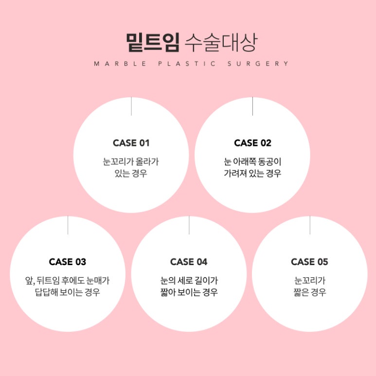 눈밑트임후기 부드러운 인상으로 변화 관련 이미지 7