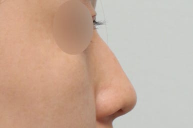 매부리코교정방법, 조화로운 코 라인의 핵심 관련 이미지 5