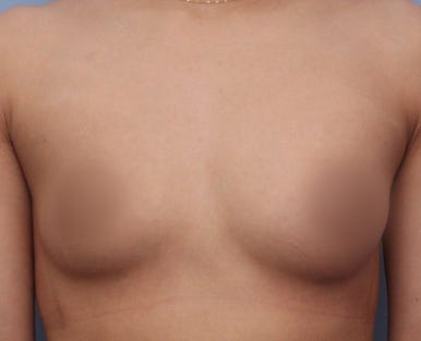 [가슴확대수술 잘하는 곳 마블성형외과 후기] 윗가슴이 없어서 나시 입을 때마다 텅 비어 보이던 과거..ㅠㅠ 관련 이미지 3