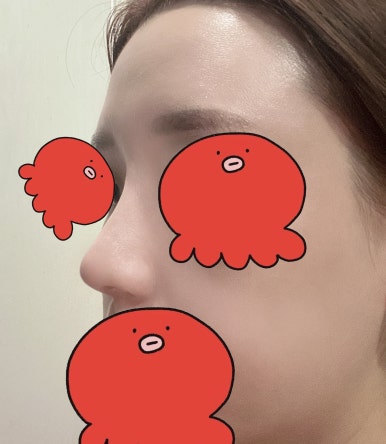 [강남성형외과 매부리코성형 후기] 부작용만 찾다가,, 금손 원장님 만나 코 정착했어요! 관련 이미지 7