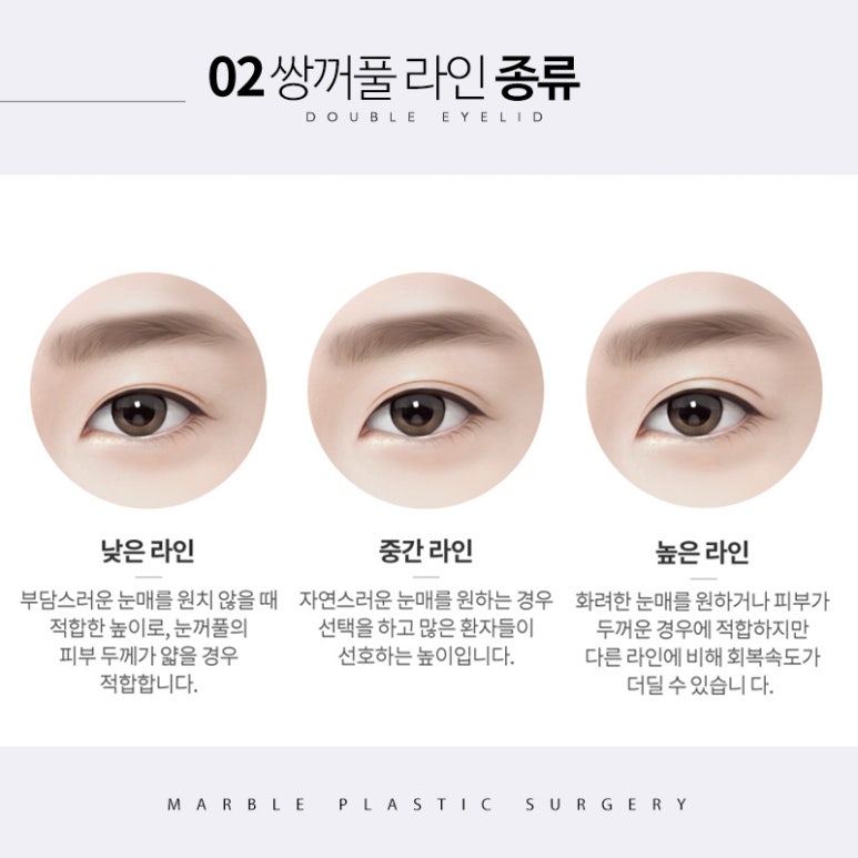 쌍수풀림 처음부터 신중하게 하면 걱정 없이 관련 이미지 4