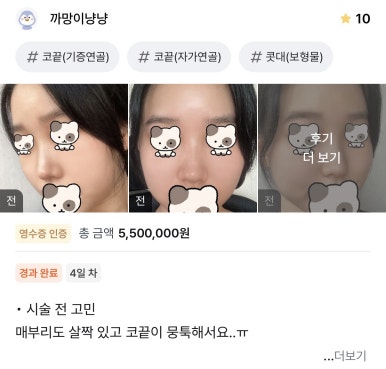 [Gangnam Station Plastic Surgery Hump Nose Surgery Review] I Escaped the Hump That Fillers Couldn’t Fix! It Looks Prettier with a Slim, Straight Line Haha image 1