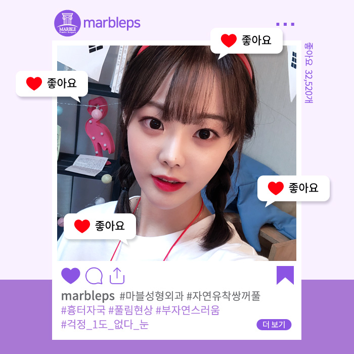 쌍꺼풀수술전후 내추럴한 인상으로 거듭나!마블성형외과의원 관련 이미지 6