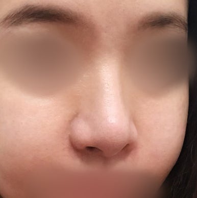 [강남역성형외과 매부리코성형 후기] 첫 수술 실패한 복코 매부리코.. 재수술로 완벽하게 성공했어요! 관련 이미지 4