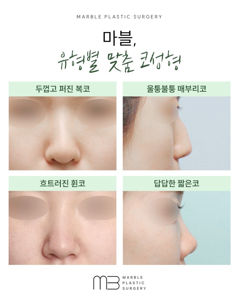 수험생 코성형, 방학동안 안전하게 준비하는 방법 관련 이미지 4