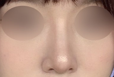 [강남성형외과 복코수술 후기] 사진 찍기 두렵던 뭉툭한 코.. 김준형원장님 만나고 세련된 라인이 됐어요! 관련 이미지 6