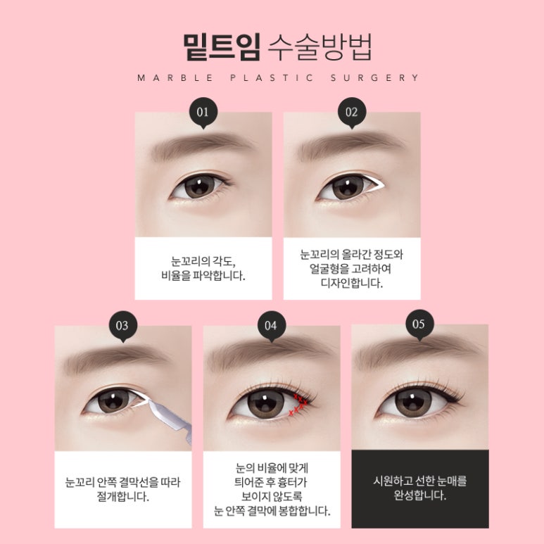 눈밑트임후기 부드러운 인상으로 변화 관련 이미지 8