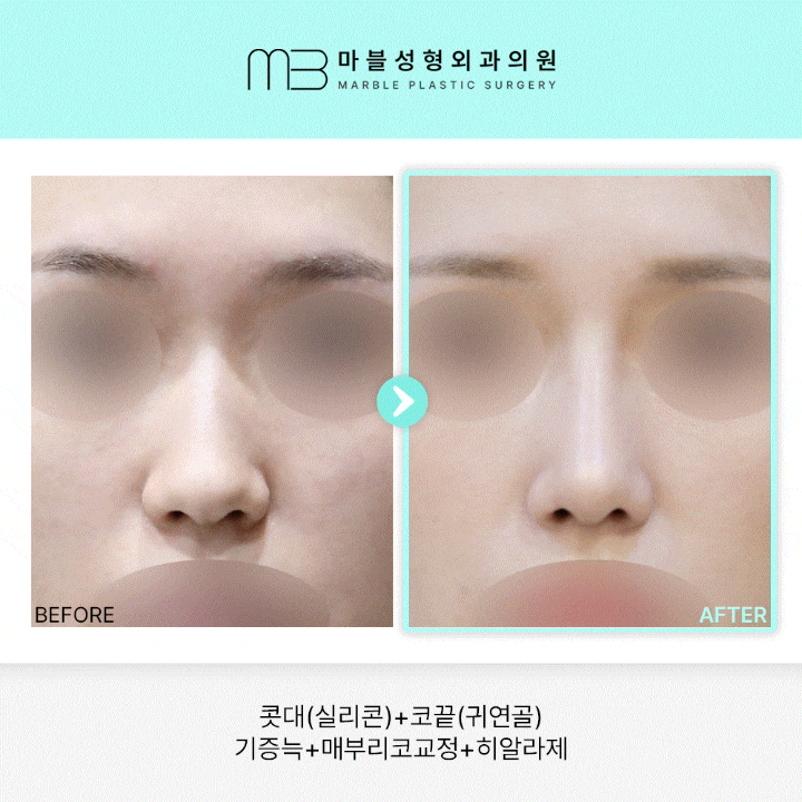 [기증늑 코성형] 매부리코교정 2개월 차: 히알라제와 기증늑 활용의 정석 관련 이미지 1