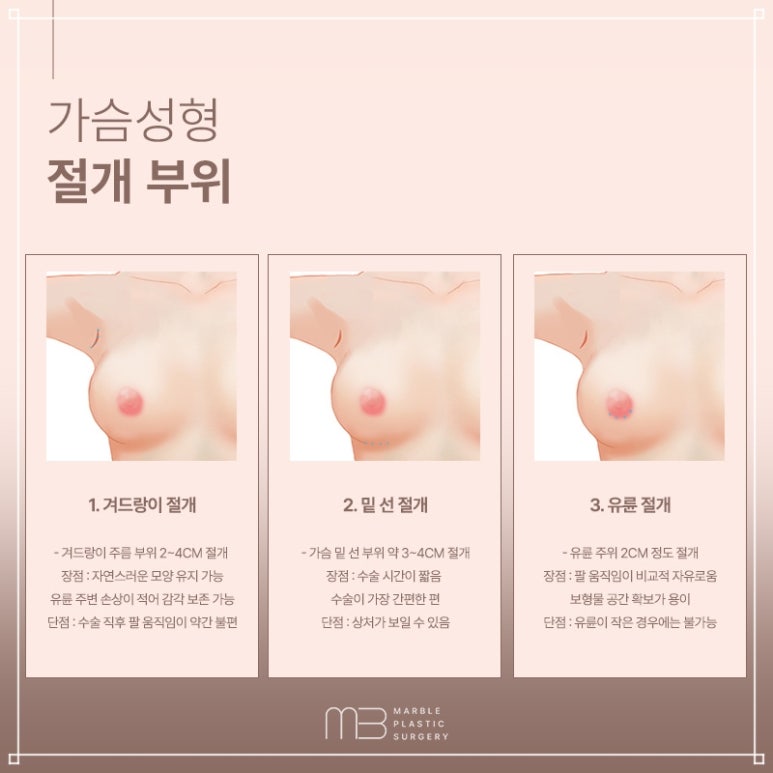모티바가슴성형추천 BEST 병원, 마블성형외과의원이 선택받는 이유 관련 이미지 5