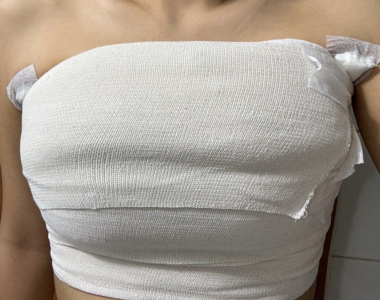 Different Texture and Volume After Breast Surgery with Motiva image 4