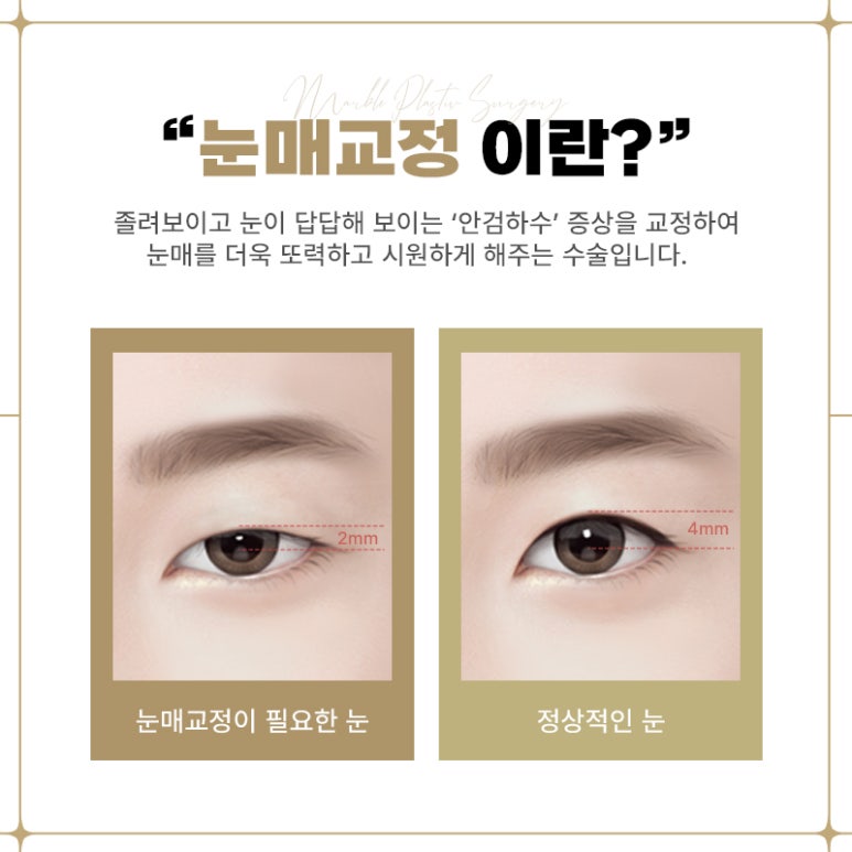눈매교정부작용 벗어날 방법 알아보기 관련 이미지 4
